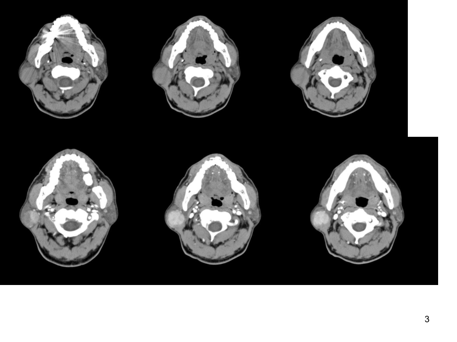 腮腺病变影像学诊断医学课件.ppt_第3页