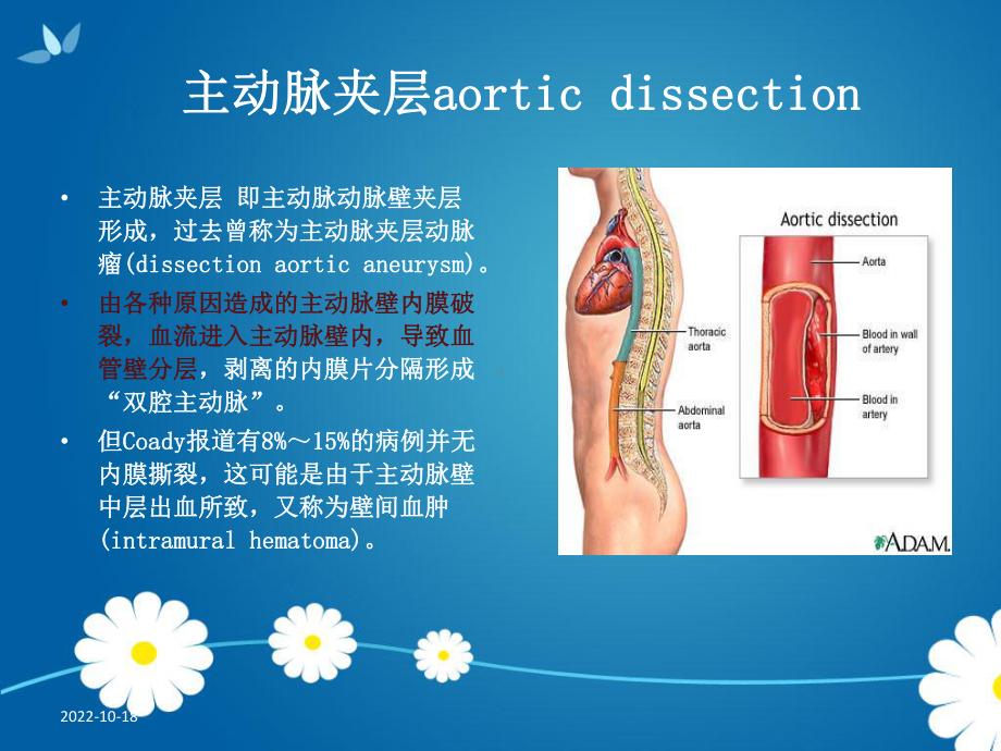 进修护士主动脉夹层支架植入护理课件.pptx_第2页