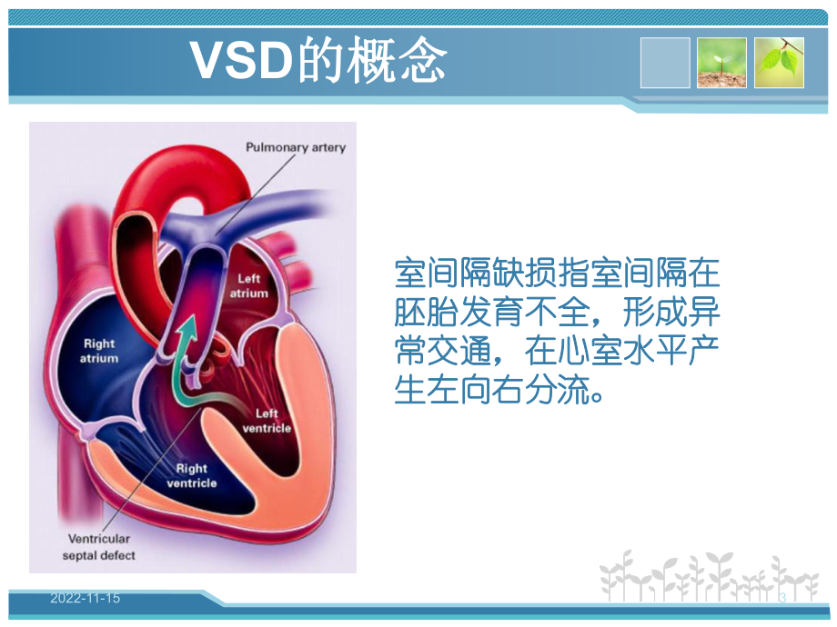 室间隔缺损修补术课件.ppt_第3页