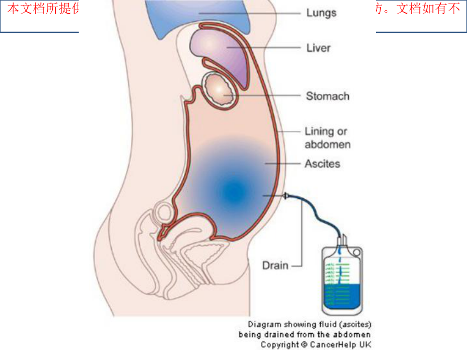 腹腔穿刺术和医疗护理培训课件.ppt_第2页