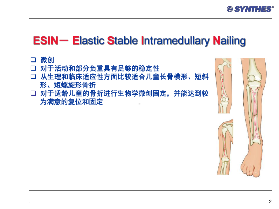 弹性髓内钉医学课件.ppt_第2页