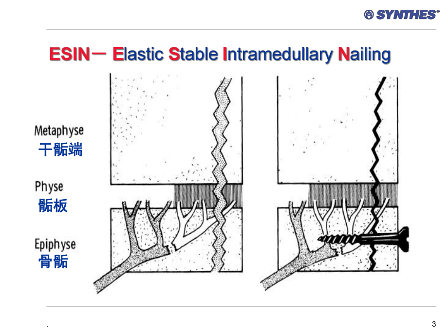 弹性髓内钉医学课件.ppt_第3页