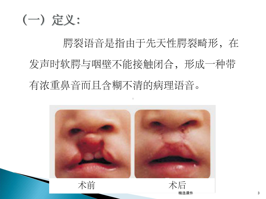 腭裂术后语音训练课件.ppt_第3页