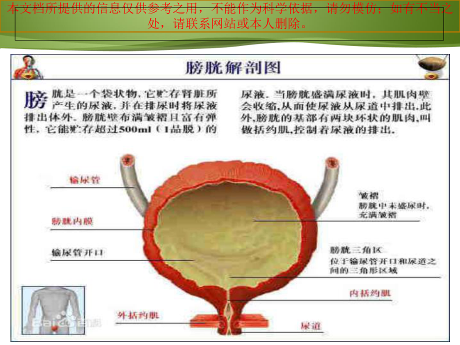 膀胱癌病人的医疗护理和健康教育培训课件.ppt_第2页