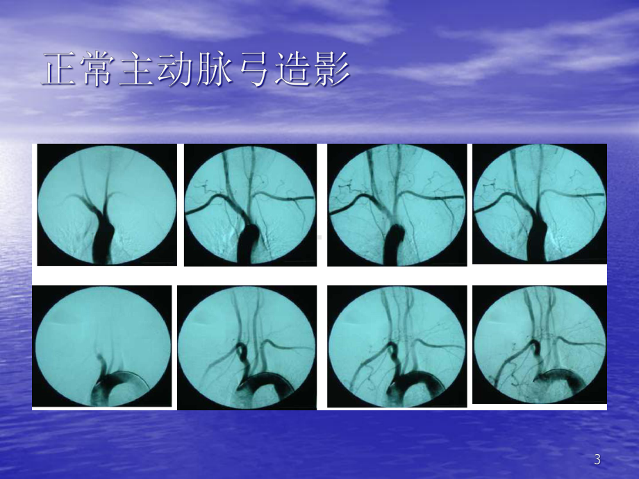 脑血管解剖与诊断课件.ppt_第3页