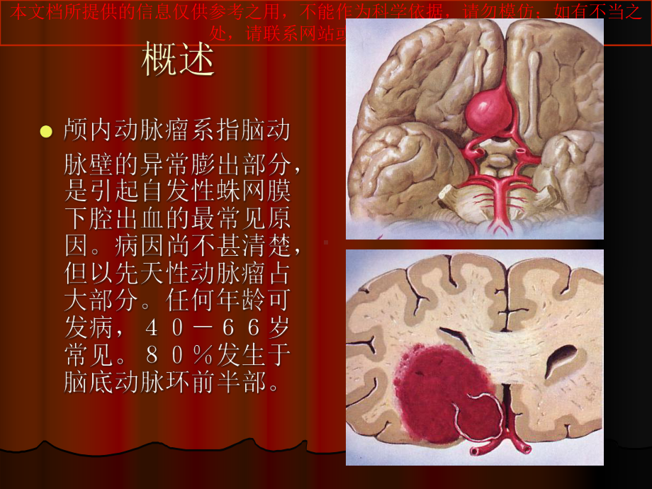 颅内动脉瘤专题医疗讲座培训课件.ppt_第1页