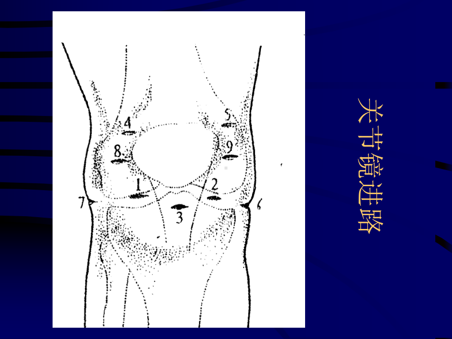 膝关节镜检查及治疗汇编课件.ppt_第2页