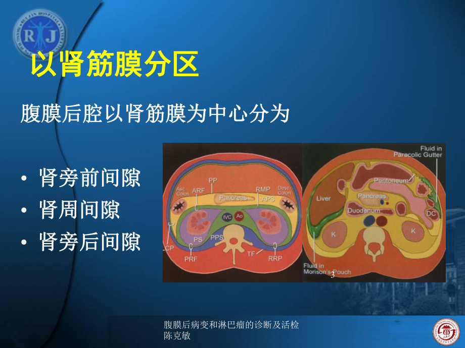 腹膜后病变和淋巴瘤的诊断及活检课件.ppt_第3页