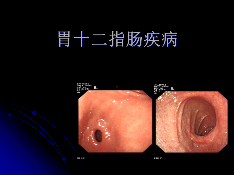 胃十二指肠疾病的内窥镜诊断课件.pptx_第1页