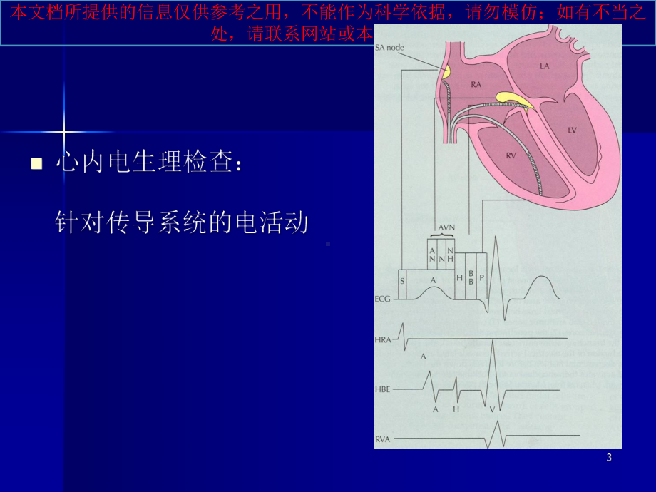 阵发性室上性心动过速培训课件.ppt_第3页