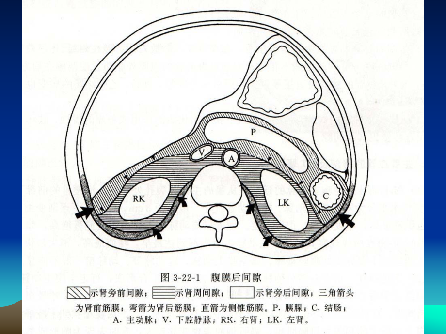 腹膜后肿瘤的CT诊疗分析培训课件.ppt_第3页