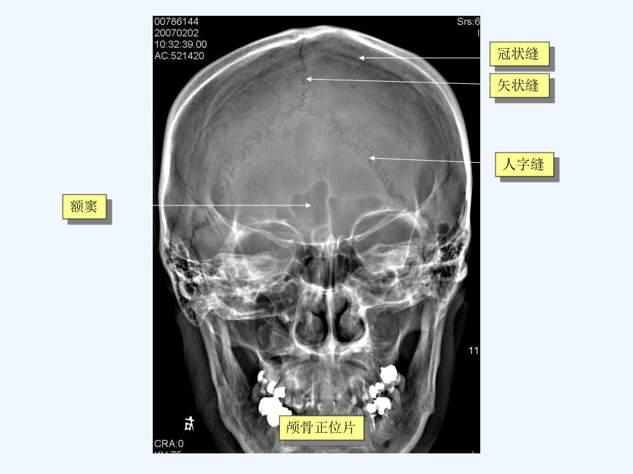 脑血管畸形诊断S课件.ppt_第2页