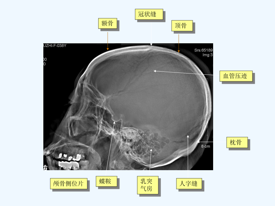 脑血管畸形诊断S课件.ppt_第3页