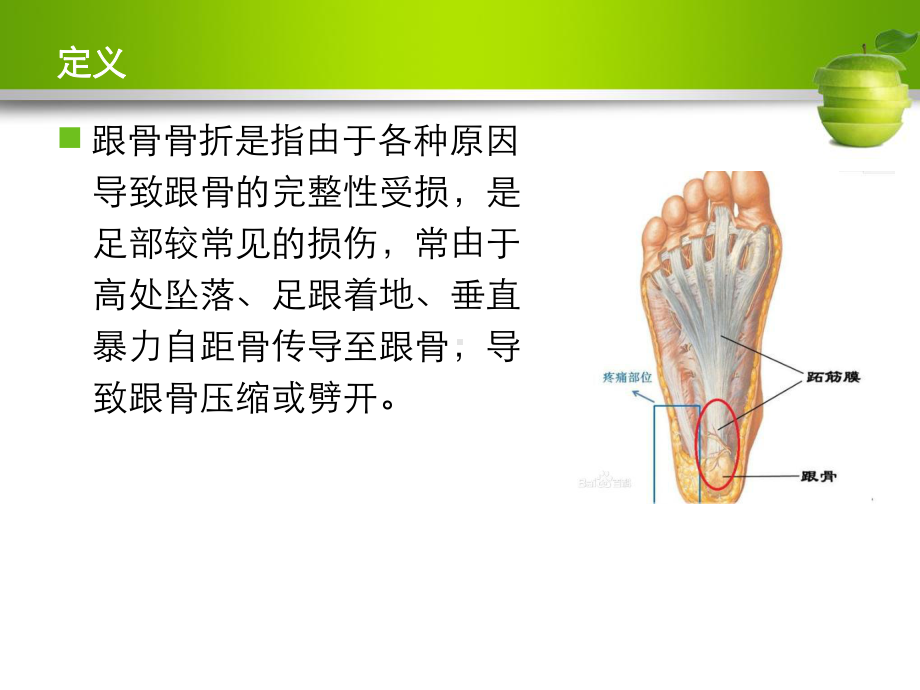 跟骨骨折护理查房实用课件.pptx_第1页