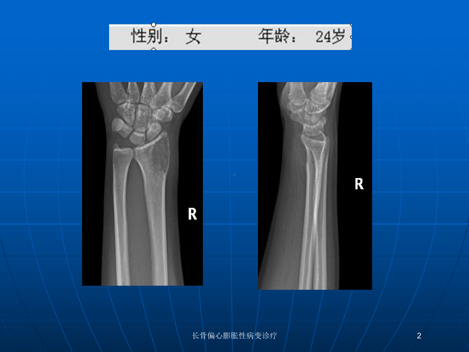 长骨偏心膨胀性病变诊疗培训课件.ppt_第2页