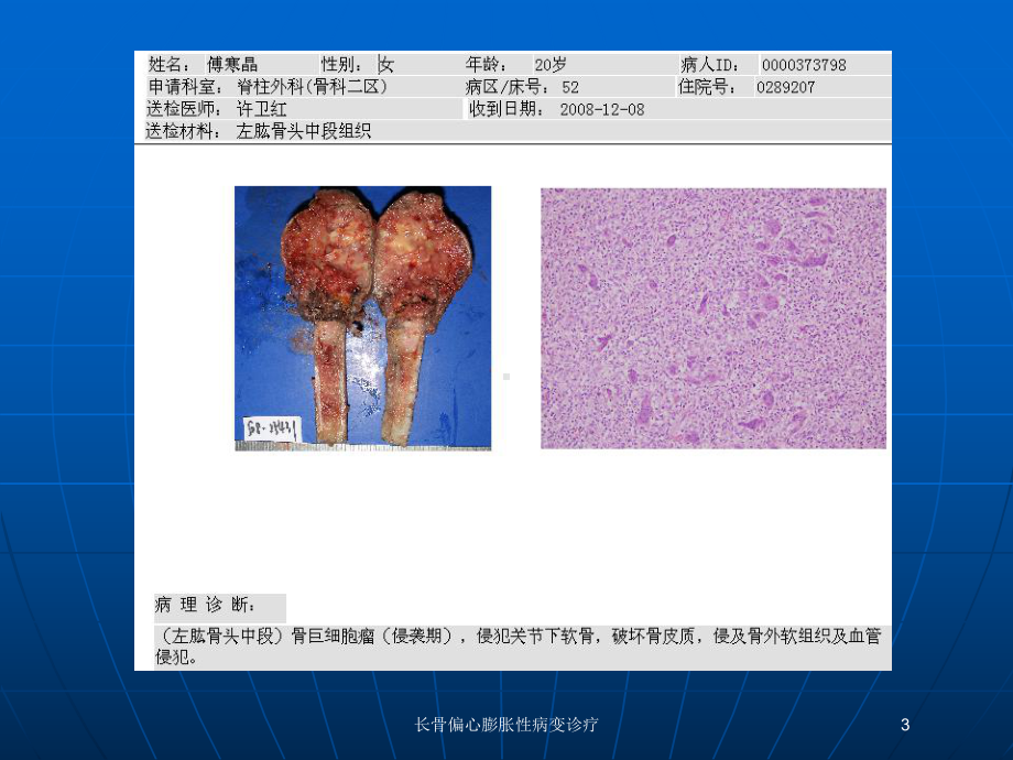 长骨偏心膨胀性病变诊疗培训课件.ppt_第3页