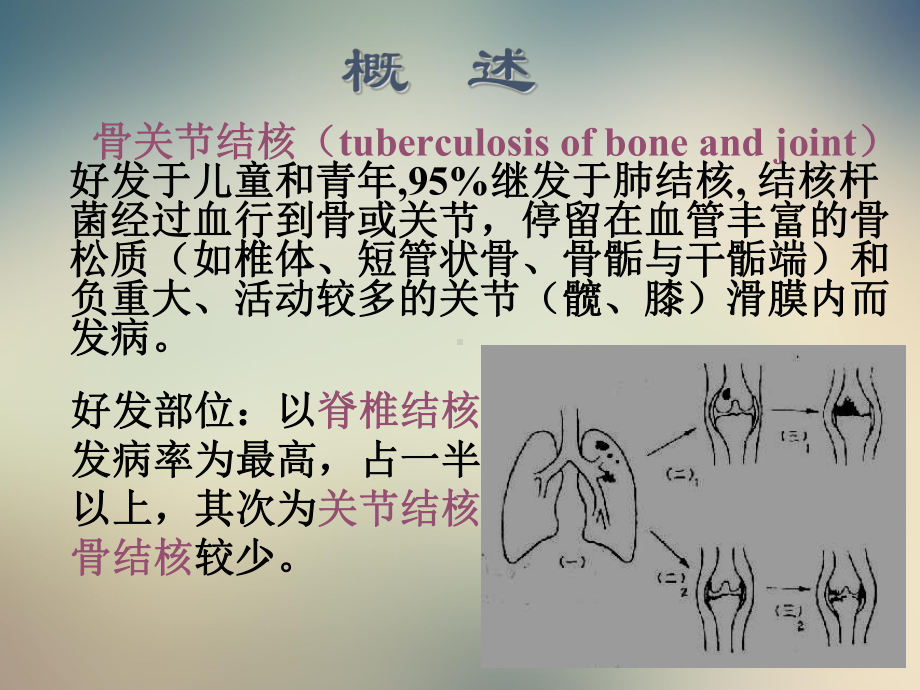 脊柱结核影像学表现课件.ppt_第3页