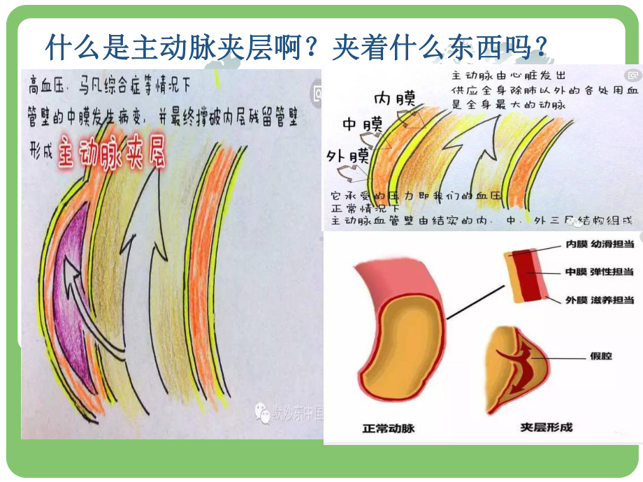 主动脉夹层的病例讨论医学课件.ppt_第3页