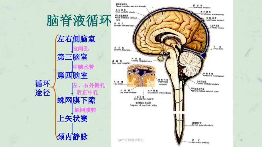 脑积水影像学特征-课件.ppt_第3页