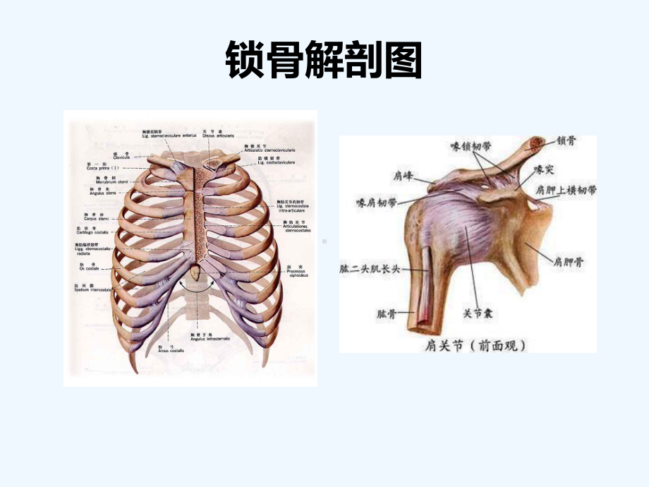 锁骨骨折护理查房课件.pptx_第2页