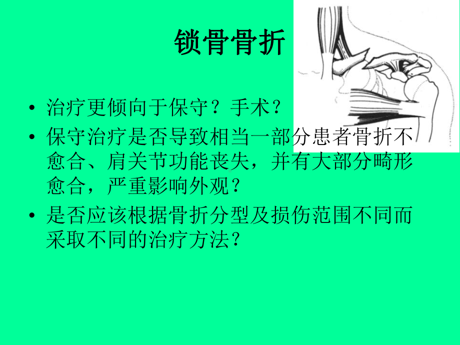 锁骨骨折治疗进展课件.ppt_第2页