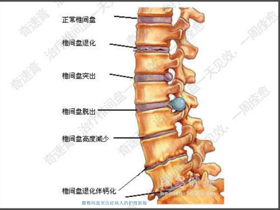 腰椎间盘突出症病人的护理新版培训课件.ppt_第3页