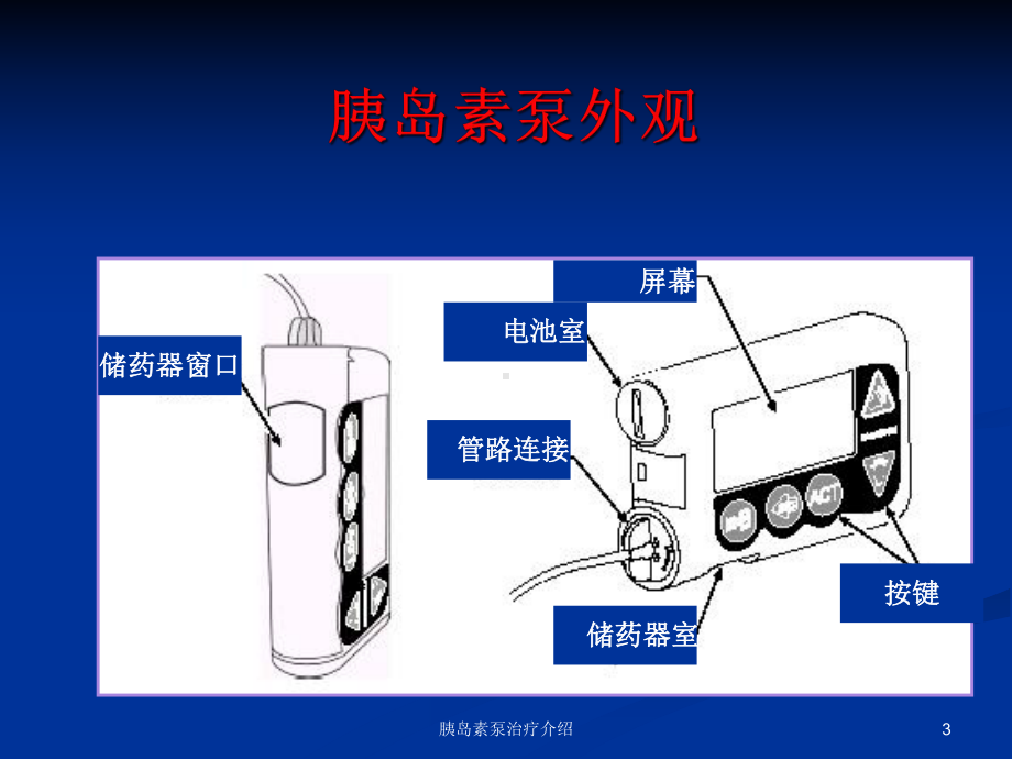 胰岛素泵治疗介绍培训课件.ppt_第3页