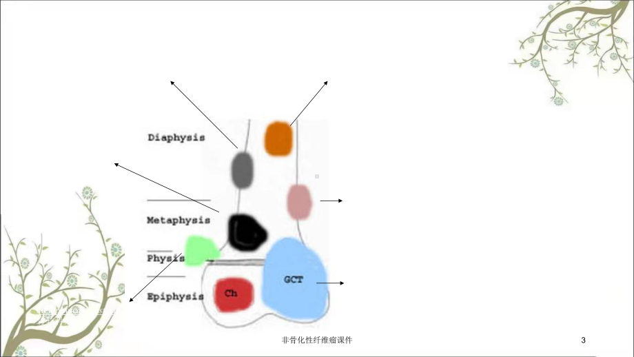 非骨化性纤维瘤课件.ppt_第3页