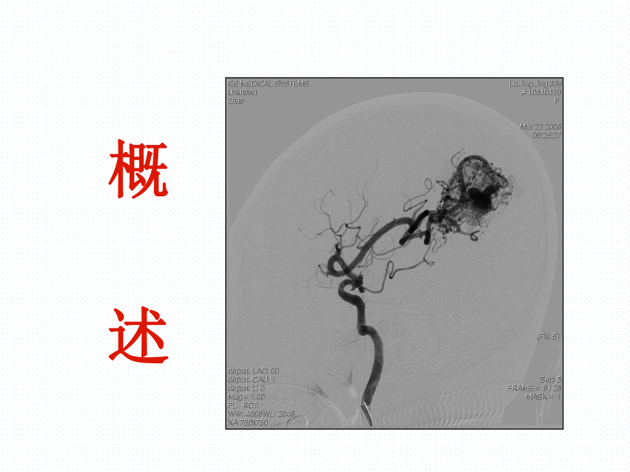 脑动静脉畸形的诊断和治疗课件.ppt_第2页