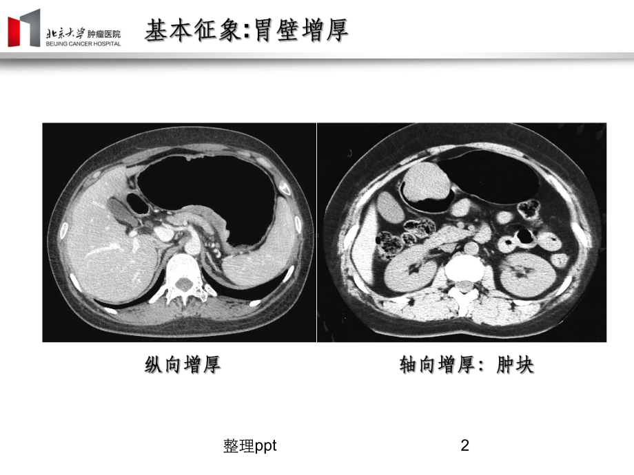 胃癌影像诊断课件.ppt_第2页