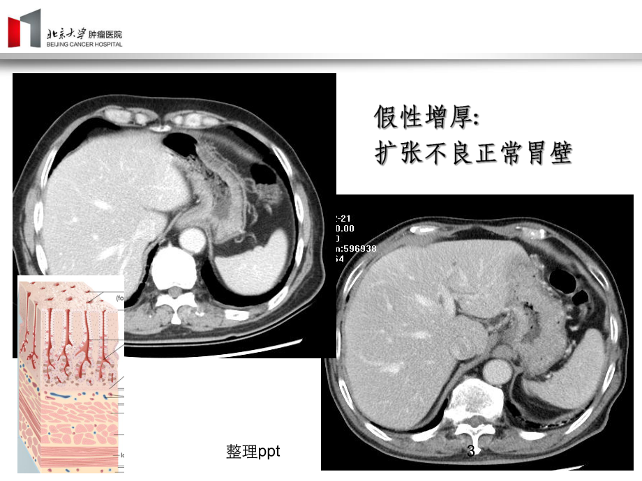 胃癌影像诊断课件.ppt_第3页