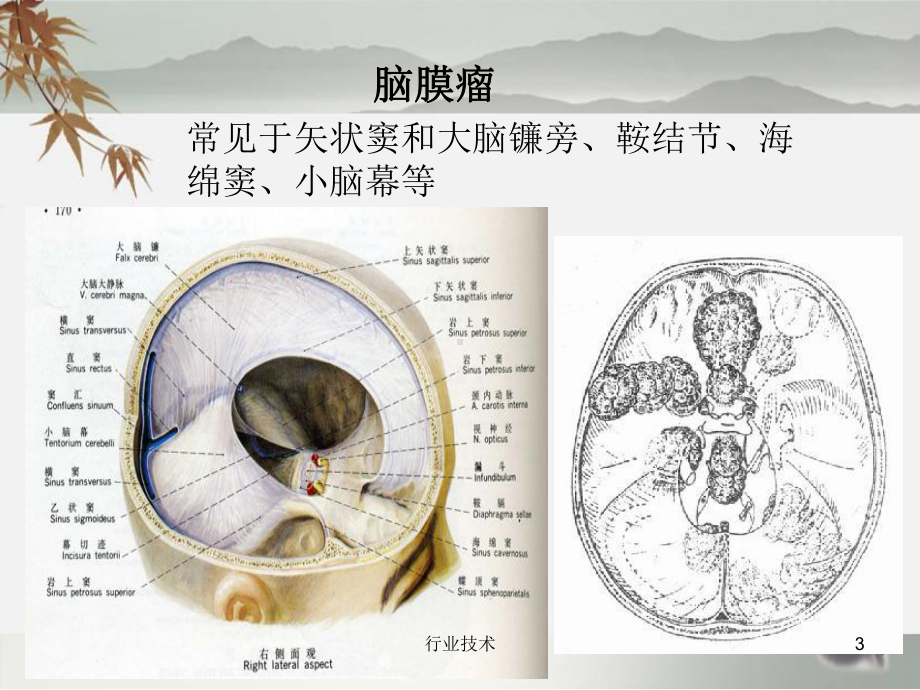 脑膜瘤护理查房(专业技术)课件.ppt_第3页