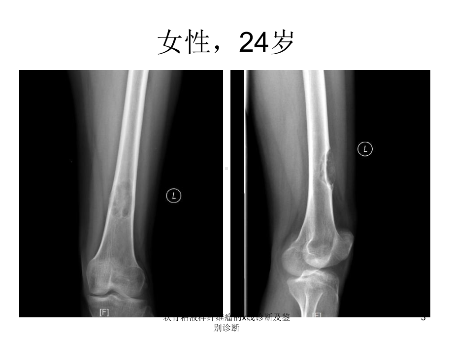 软骨粘液样纤维瘤的x线诊断及鉴别诊断课件.ppt_第3页