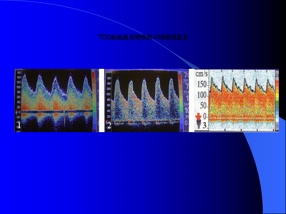 脑血流速度增快或减慢病理意义-课件.ppt_第3页