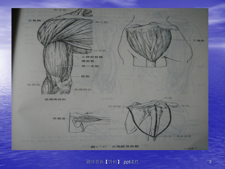 锁骨骨折骨科-课件.ppt_第3页