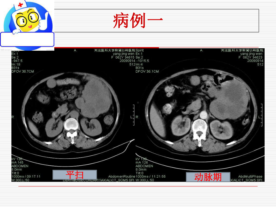 胃肠道间质瘤的影像诊断-课件.ppt_第3页