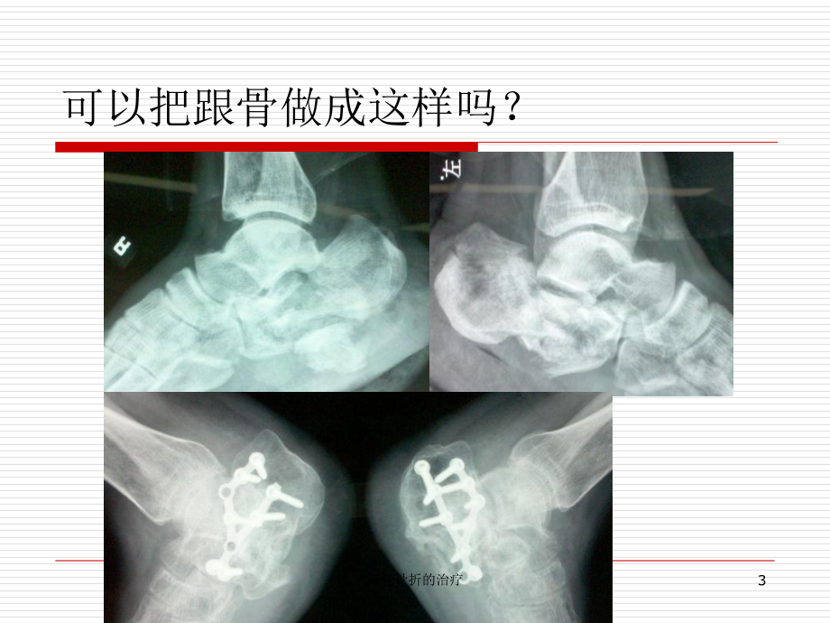 跟骨骨折的治疗培训课件.ppt_第3页