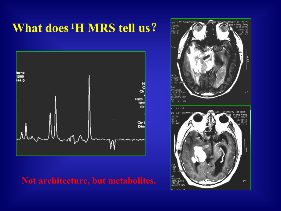 磁共振氢质子波谱在颅脑疾病诊断的临床应用-课件.ppt_第2页