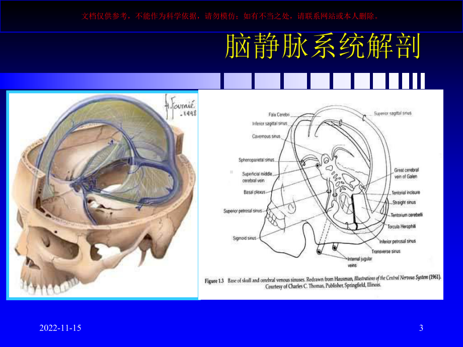 脑静脉和静脉窦血栓形成新进展课件.ppt_第3页