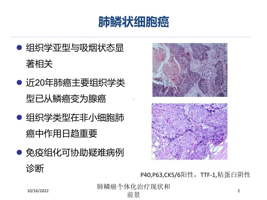 肺鳞癌个体化治疗现状和前景培训课件.ppt_第2页