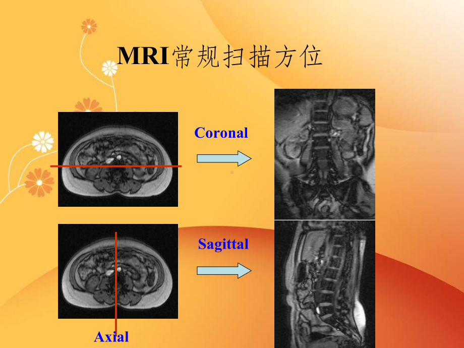 脊柱常见疾病的MRI诊断课件.ppt_第3页