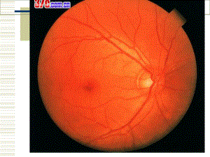 视网膜病医学知识专题讲座培训课件.ppt