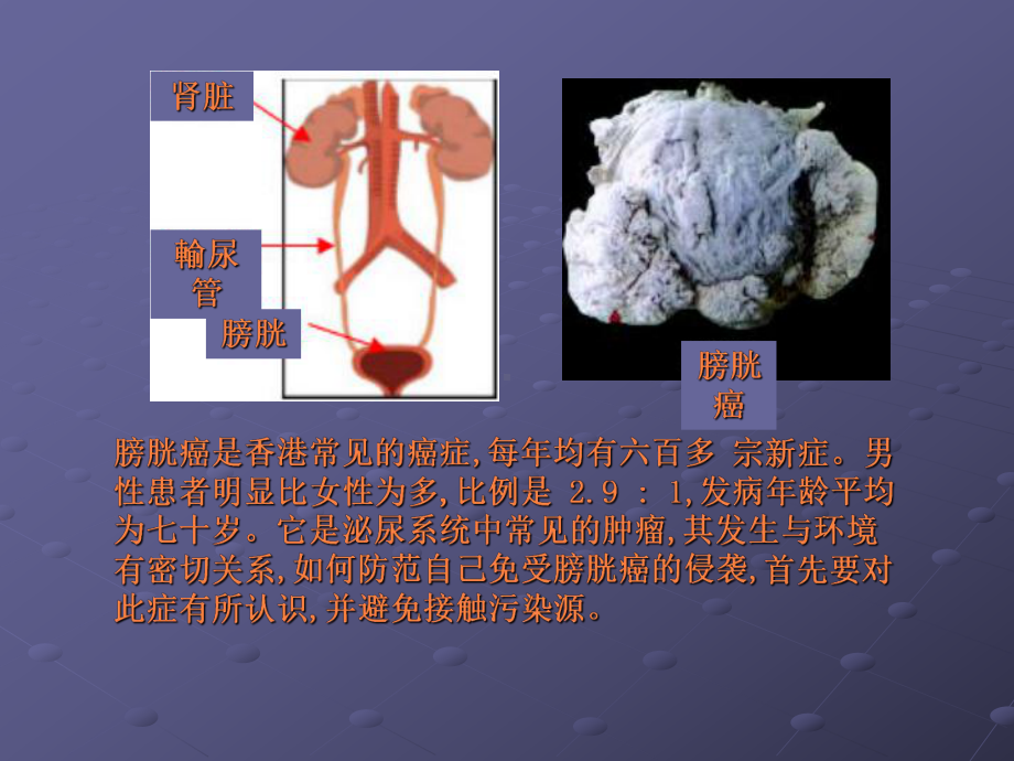 膀胱癌的症状课件.pptx_第2页