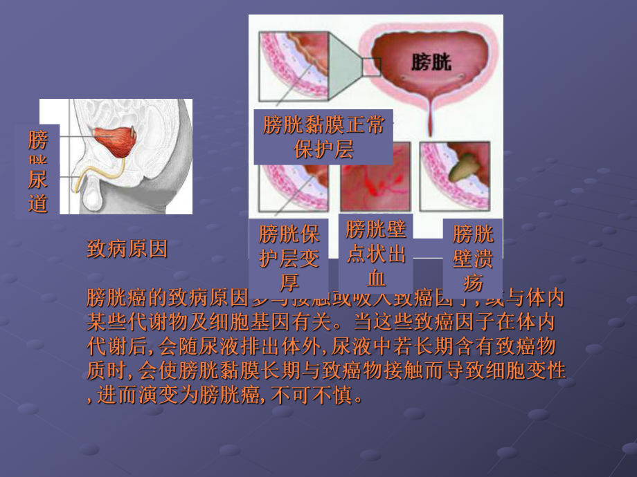 膀胱癌的症状课件.pptx_第3页