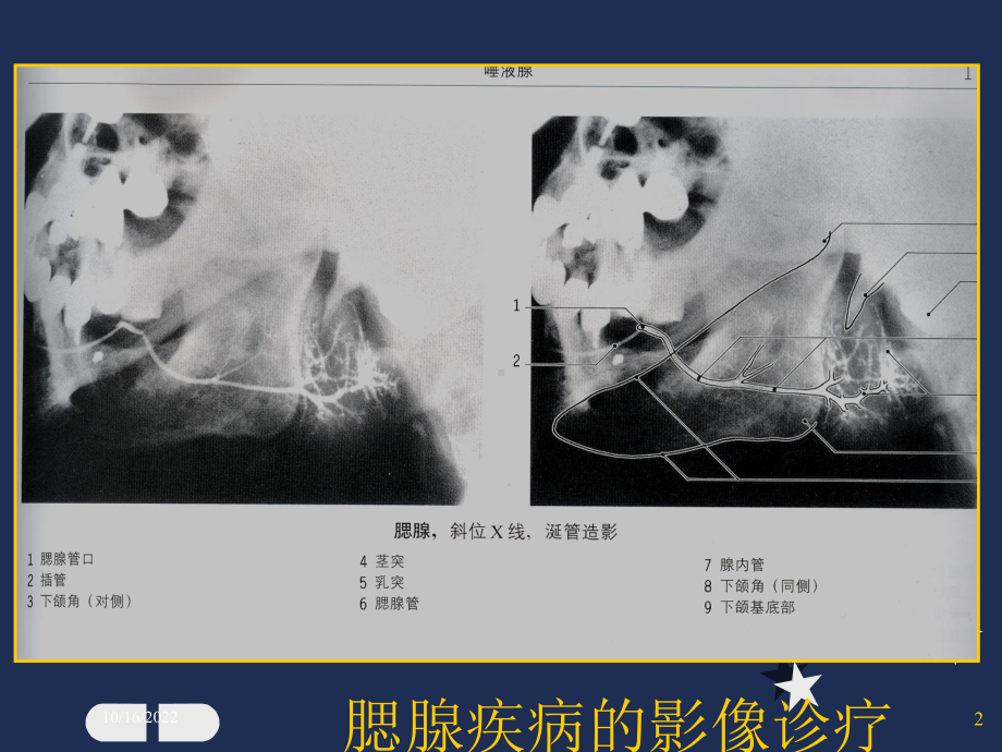 腮腺疾病的影像诊疗培训课件.ppt_第2页