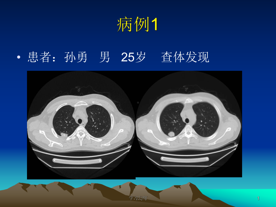 肺错构瘤影像表现课件.ppt_第1页