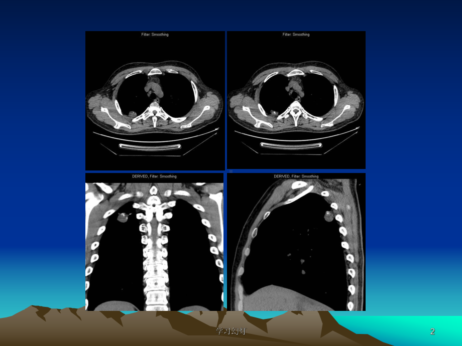 肺错构瘤影像表现课件.ppt_第2页