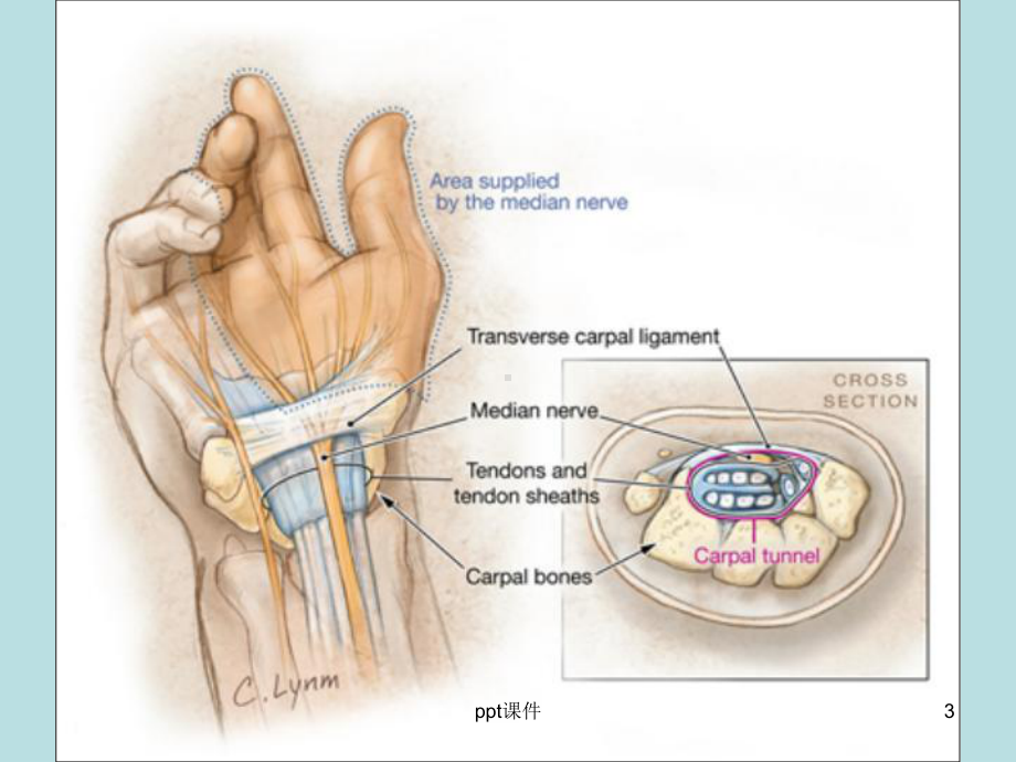 腕管综合征-课件.ppt_第3页