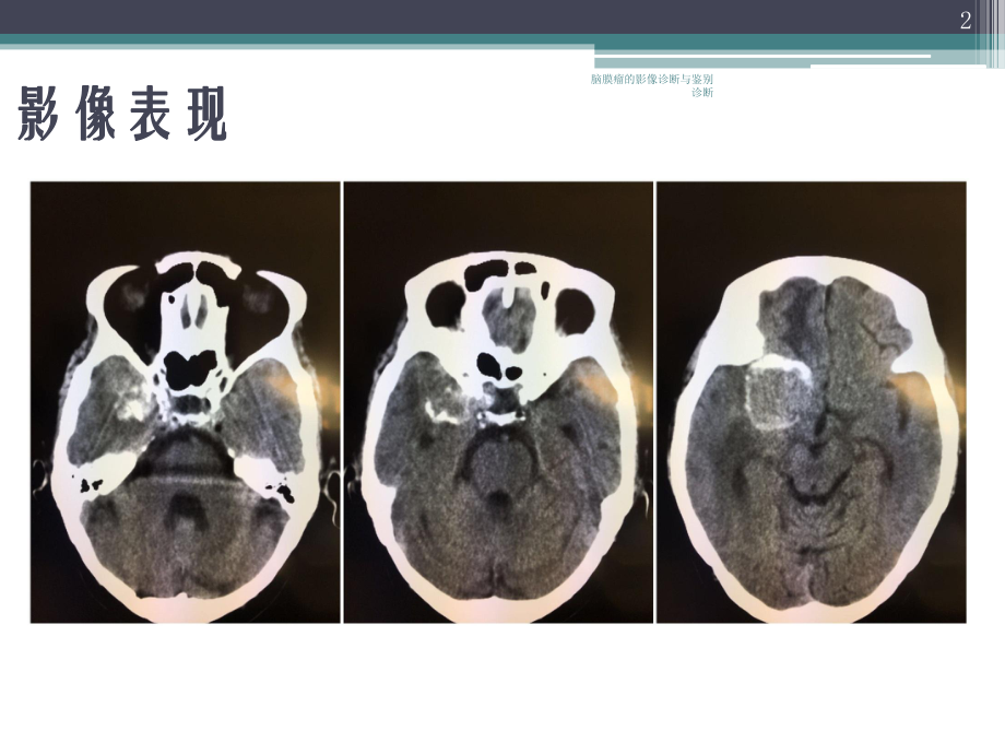 脑膜瘤的影像诊断与鉴别诊断培训课件.ppt_第2页