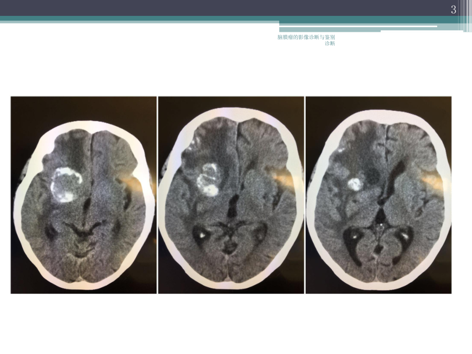脑膜瘤的影像诊断与鉴别诊断培训课件.ppt_第3页